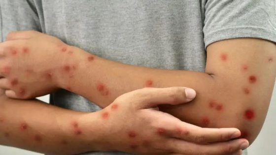 تحذير طبي: تنقلات العطلة المدرسية تُشعل فتيل تفشي الحصبة في المغرب